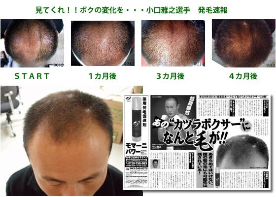 小口雅之とカツラと毛生え薬 芸能人のハゲ 薄毛さんいらっしゃ い
