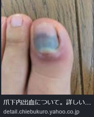 ヒマネタ 足の爪が生え変わるのに１年 ２年も 丹沢ｚ３の気まぐれブログ