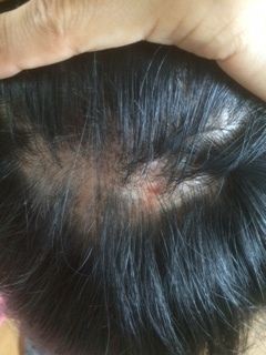 アトピー 15 8 26 抜毛症 抜毛癖 トリコチロマニア の完治を目指すblog