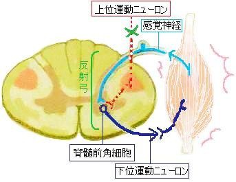 カチカチな麻痺 ゆるゆるな麻痺 きゃばりこ記 カチカチな麻痺 ゆるゆるな麻痺 きゃばりこ記