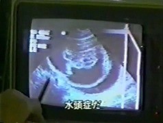 被曝した妊婦の奇形児発生率４倍以上 特に 水頭症 チェルノブイリ小児病棟 5年目の報告 動画 文字おこし5 最終回 座間宮ガレイの世界