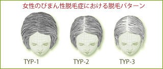 芸能人も薄毛に悩む 女性の薄毛急増 薄毛に悩む人々に贈る情報誌