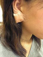 耳のしこり摘出 どうでもよくなってきたタイトル