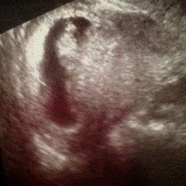 診察結果 9w2d 暇はキライ バセドウ病 アイソトープ 切迫早産の記録