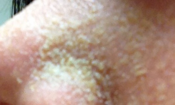 水洗顔 三週間 水洗顔で角質培養してみたら鼻がヤバいことになったwwwww 画像あり 肌速