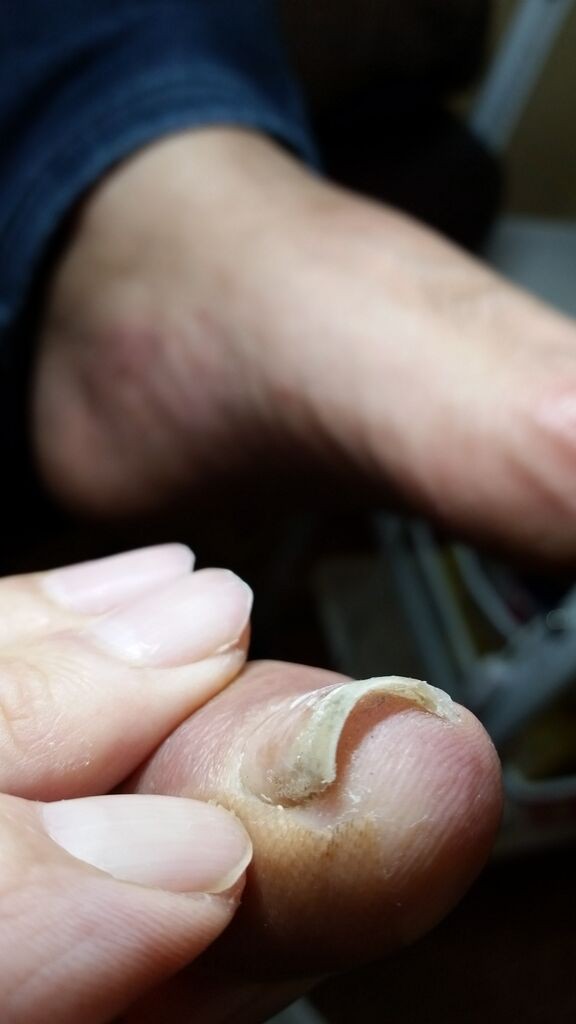 その痛みは爪の棘ではありませんか 巻き爪 外反母趾 フットケア専門 クリアプラス 長崎 ひととき 島原