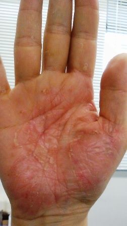 足 痒い 手のひら の 裏 足の裏がかゆい、湿疹やぶつぶつの原因と対処・治療法｜田辺三菱製薬｜ヒフノコトサイト