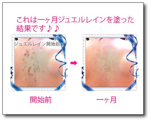 ジュエルレインの効果が増す方法 結婚式まで時間がない人は注目 背中ニキビを安く治してウエディングドレスを着るならジュエルネイン ちえの体験記