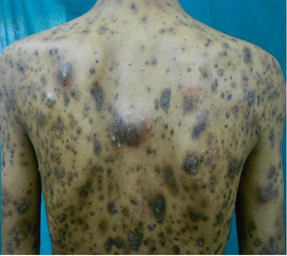 ゴミ屋敷の住人は精神疾患なのか それとも 心の傷のせいなのか ホーディング障害 買いだめ障害 溜め込み障害 ディオゲネス症候群 その２ 場末ｐ科病院の精神科医のblog