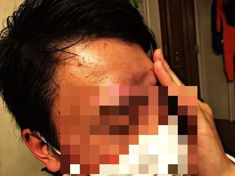 画像あり 先輩が後輩にデコピン 頭蓋骨が割れてヘコむ事態に 閲覧注意 ネクスト速報