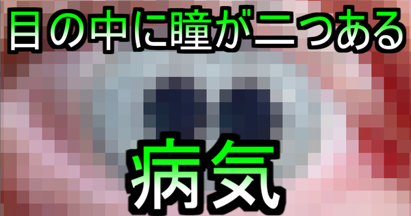 画像あり 目の中に 瞳が二つある 病気が話題に これはヤバい 閲覧注意 ネクスト速報