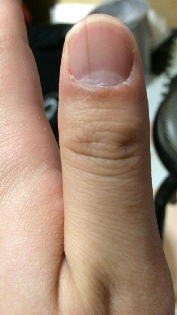 爪の中に黒い縦線ある奴ｗｗｗｗｗｗｗｗｗｗｗｗｗｗｗｗｗｗｗｗ まとめたニュース