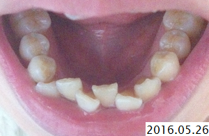 歯列矯正を決めた経緯 1 2 歯列矯正 32歳 表側で叢生を治す