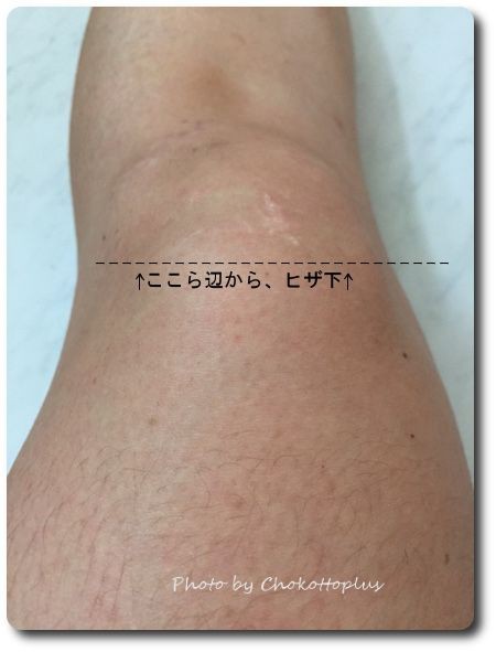 ミュゼでひざ下脱毛しました 10日経過後の様子 写真あり ちょこっとプラスで素敵な生活を