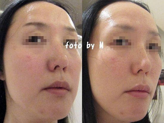 Tbc 毛穴エステ フェイシャルコース 体験3000円 5000円に行った感想 キャビテーション 体験 はしごした口コミ ビフォーアフター写真あり