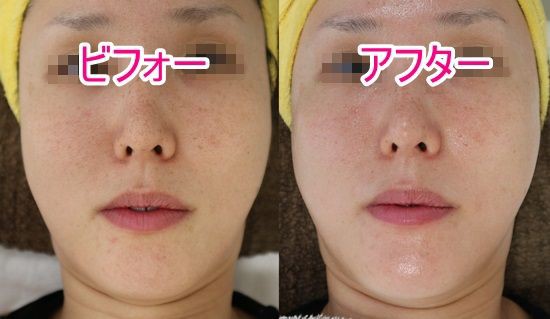 Vitule ゔぃとぅれ 顔エステ フェイシャル革命コース 価格 フォトフェイシャル最安値 体験してきた キャビテーション 体験 はしごした口コミ ビフォーアフター写真あり