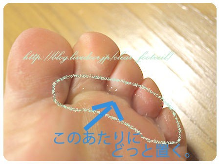 水虫を自分で治したい 水虫の薬おすすめ 塗り方 クリアフットヴェール 口コミ体験 クリアフットヴェール 口コミ 効果 自宅で治す水虫薬 おすすめ ブログ 画像付き
