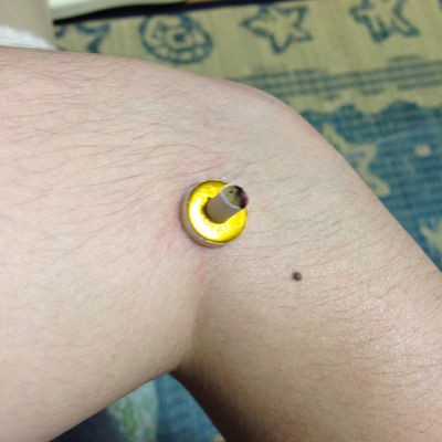 お灸をすえる その２ こすもん日記