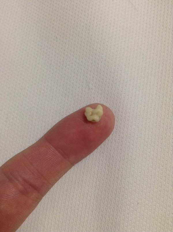 特大臭い玉取れたｗｗｗｗｗｗｗｗ はれぞう