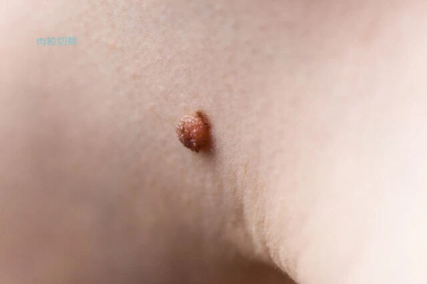 皮膚に小さな肉質の隆起がある可能性は何ですか それは癒されなければなりませんか 1つの記事ではっきりと話してください 気にしないでください 永遠の戸惑いを持つ易者さん 皮膚に小さな肉質の隆起がある可能性は何ですか それは癒されなければなりませんか 1つの記事ではっきりと話してください 気にしないでください 永遠の戸惑いを持つ易者さん