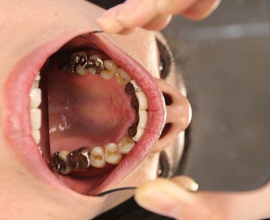 ゆかりさんの前裏銀歯 新 デブ狂四郎のblog