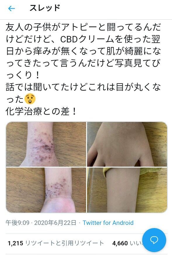 心と身体 瀉血 吸玉 吸引でアトピー治療 その10 びんたんde５ちゃんねる