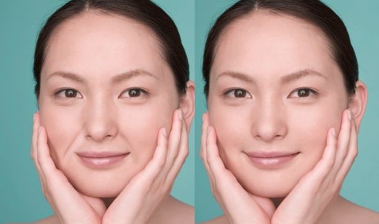 エステナードリフティを使用して ほうれい線 を消すことに成功した３０代女性実践記 エステナードリフティで ほうれい線 が消えた ３０代女性実践記