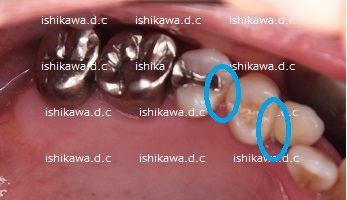 インレー 詰め物 の金属色が透けて黒くなる だけではない Dr イチローのホップ ステップ ジャンプ