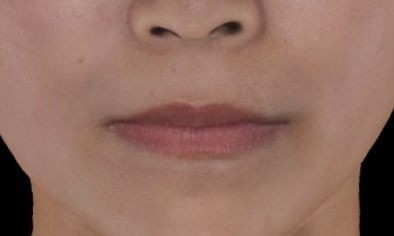 リップのヒアルロン酸 鼻下を短く見せる Dr Fumiの美容blog
