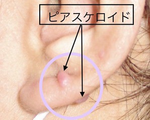 ピアスケロイド Dr Fumiの美容blog