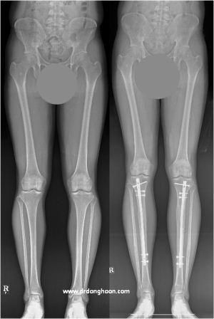 骨延長手術の後に 延長した骨がでこぼこしてますが問題はないんでしょうか Dr Donghoonのブログ