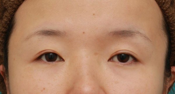 昨日アップした 眼球自体が小さい目に対して 目頭切開 眼瞼下垂手術をした症例写真の解説です 高須クリニック高須幹弥の美容整形症例画像写真集