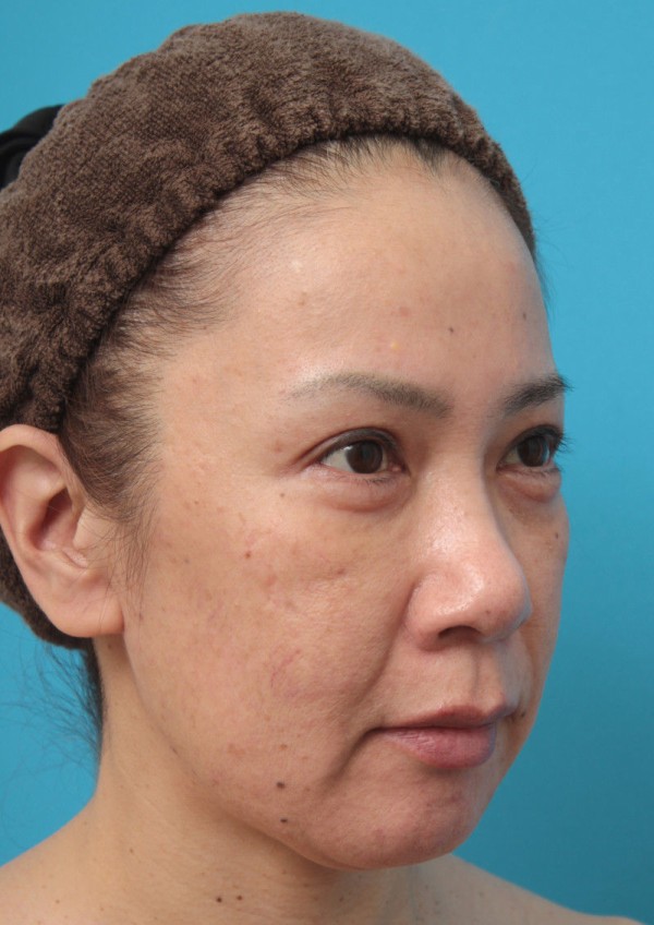 先日アップした ミニフェイスリフトで頬のたるみがリフトアップした50代女性の症例写真の解説 高須クリニック高須幹弥の美容整形症例画像写真集