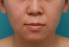 バッカルファット除去手術で頬の膨らみとたるみを改善させた代女性の症例写真の腫れが引いていくダウンタイム経過画像です 高須クリニック高須幹弥の美容整形症例画像写真集