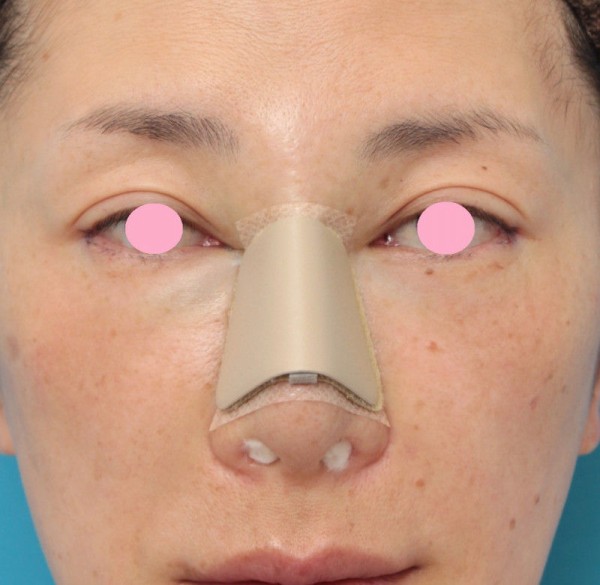 骨切り幅寄せ手術で鼻の横幅を小さくした40代女性の症例写真の腫れが引いていく経過画像です 高須クリニック高須幹弥の美容整形症例画像写真集