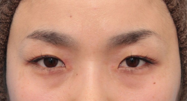 目頭切開で蒙古襞の突っ張りをとり 目を内側に広げた30代女性の腫れが引いていく経過画像です 高須クリニック高須幹弥の美容整形症例画像写真集