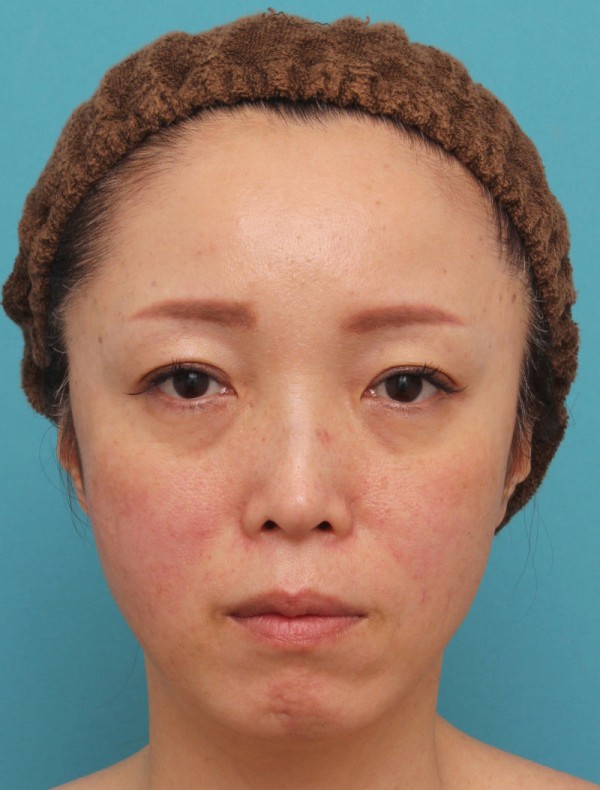 頬が痩けている女性にヒアルロン酸注入で肌の張りを出した症例の腫れが引いていく経過画像です 高須クリニック高須幹弥の美容整形症例画像写真集 頬が痩けている女性にヒアルロン酸注入で肌の張りを出した症例の腫れが引いていく経過画像です 高須クリニック高須幹弥の美容整形症例画像写真集