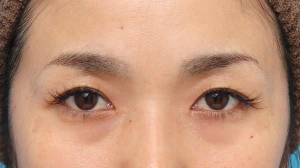 目頭切開で蒙古襞の突っ張りをとり 目を内側に広げた30代女性の腫れが引いていく経過画像です 高須クリニック高須幹弥の美容整形症例画像写真集