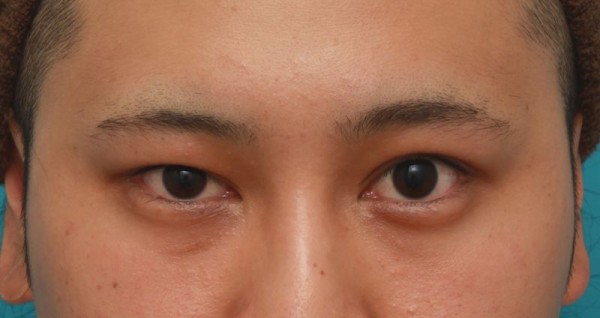 片目の眼瞼下垂を手術で治し ほぼ左右対称にした症例写真の腫れが引いていくダウンタイム経過画像です 高須クリニック高須幹弥の美容整形症例画像写真集