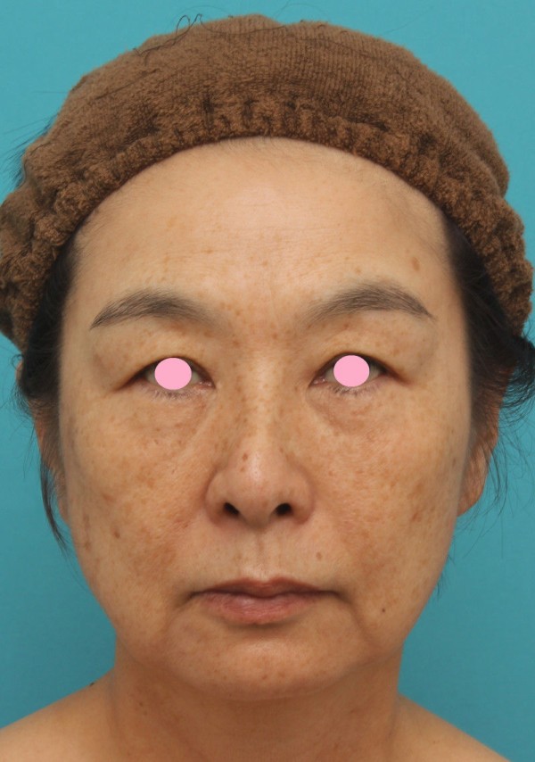 ミディアムフェイスリフトで頬のたるみをリフトアップさせた50代後半女性の症例写真です 高須クリニック高須幹弥の美容整形症例画像写真集