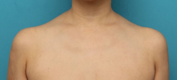 先日アップした 美人肩ボトックス注射で肩の筋肉 僧帽筋 を萎縮させスッキリした症例写真の解説です 高須クリニック高須幹弥の美容整形症例画像写真集