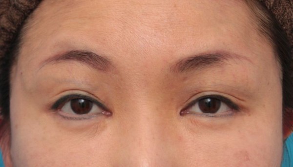 他院で切られ過ぎた目頭切開を蒙古襞形成で修正した症例写真の経過画像です 高須クリニック高須幹弥の美容整形症例画像写真集