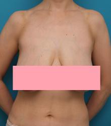 下垂乳房 垂れ乳 に乳房吊り上げ術を行った症例写真アップ 高須クリニック高須幹弥の美容整形症例画像写真集