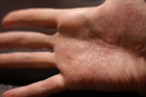 ８月２０日 肌日記