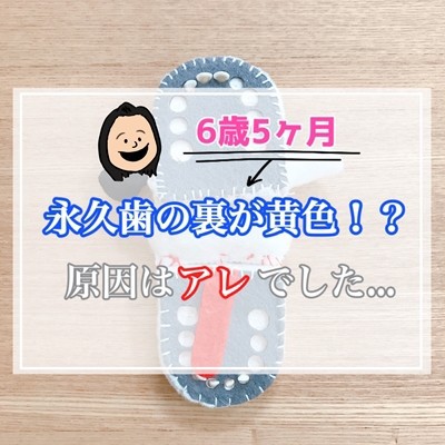 画像有り 子供 6歳年長 の永久歯の裏が黄色い 原因が判明しました 7本目の乳歯が抜けた えりゐのｅｖｅｒｙ ｄｉａｒｙ Powered By ライブドアブログ