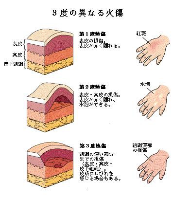 火傷 手当て