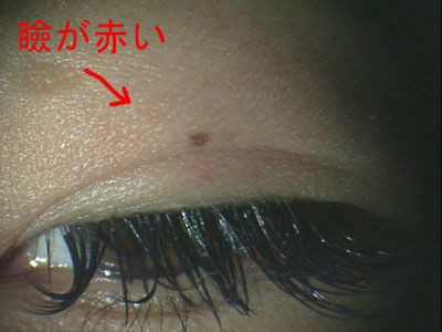 まつげエクステンション マツエク の危険性 グルー 接着剤 のアレルギーによるトラブル ある奈良県の眼科医が目について書いたブログ
