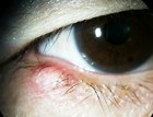 ものもらいはうつる うつらない 伝染すると思われているのはものもらいの語源から ある奈良県の眼科医が目について書いたブログ