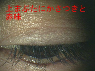 まつげエクステンション マツエク の危険性 グルー 接着剤 のアレルギーによるトラブル ある奈良県の眼科医が目について書いたブログ