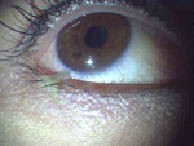 目やにでわかる目やにの原因 細菌性結膜炎 アレルギー性結膜炎 ウイルス性結膜炎 ある奈良県の眼科医が目について書いたブログ